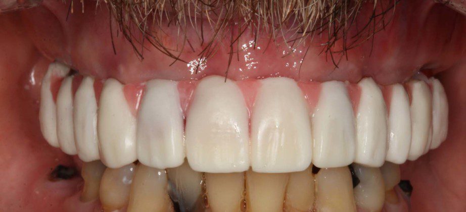 Prototype-wax-up-try-in. Used to determine length, width, overall smile, and bite (lips retracted).