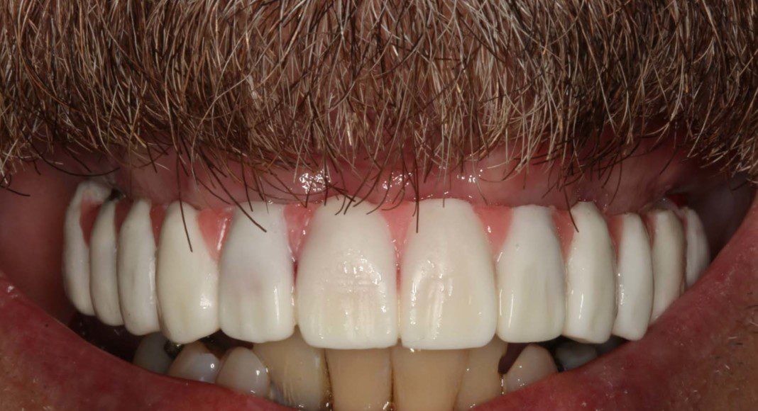 Prototype-wax-up-try-in. Used to determine length, width, overall smile, and bite (smile).