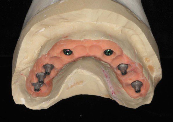 Frontal view, master cast with titanium cylinders before cementation of the zirconium bridge.