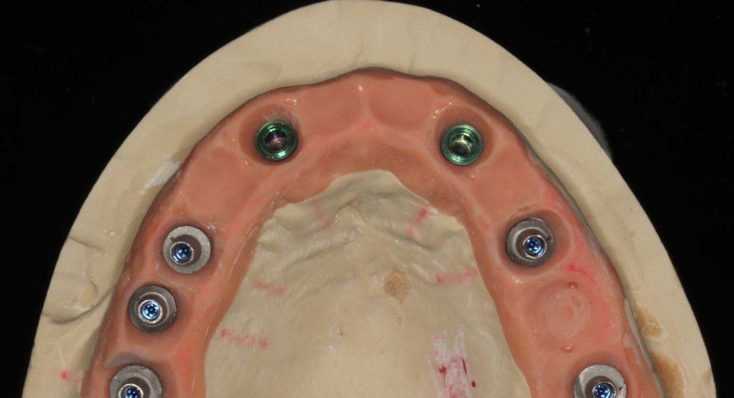 Occlusal view, master cast with titanium cylinders before cementation of the zirconia bridge.