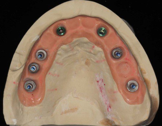 Occlusal view, master cast with titanium cylinders before cementation of the zirconium bridge.