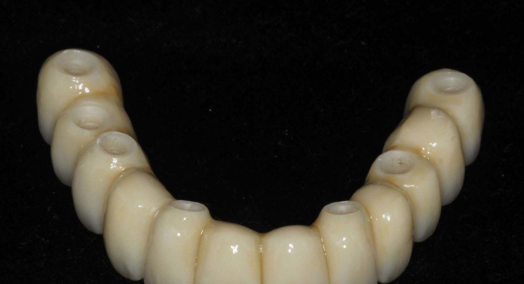 Zirconium bridge before cementation to the titanium cylinders (frontal view).