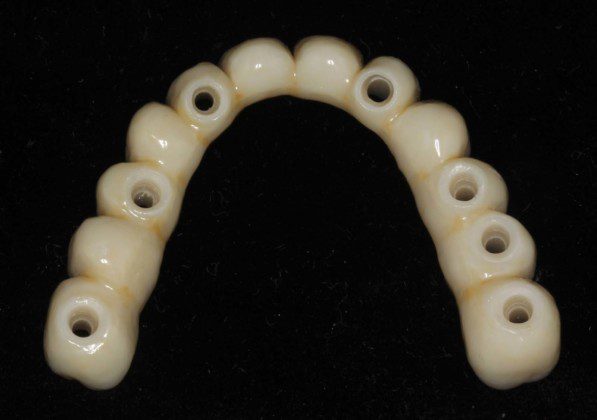 Zirconium bridge before cementation to the titanium cylinders (tissue view).