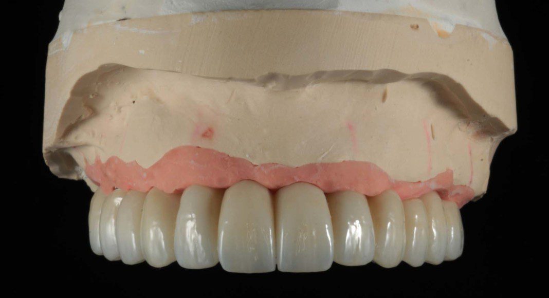 Zirconium bridge on master cast (frontal view).