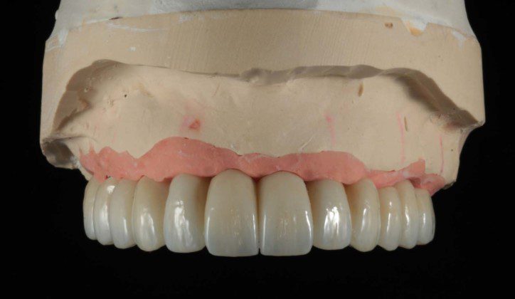 Zirconium bridge on master cast (frontal view).