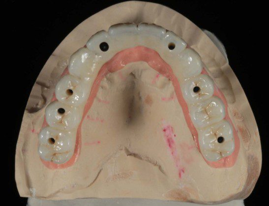 Zirconium bridge on master cast (occlusal view).