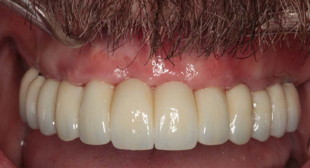 Upper Fixed Implant Bridges Immediate Fixed Temporary Bridge