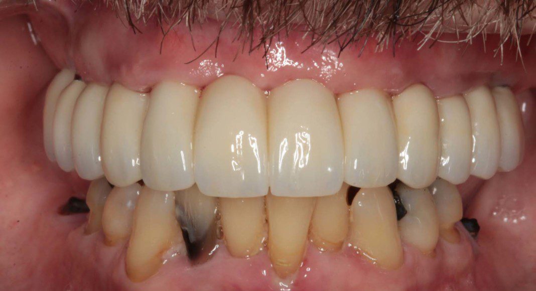 Final, zirconia bridge (frontal view, lips retracted, patient biting).