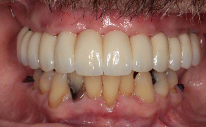 Final, zirconia bridge (frontal view, lips retracted, patient biting).