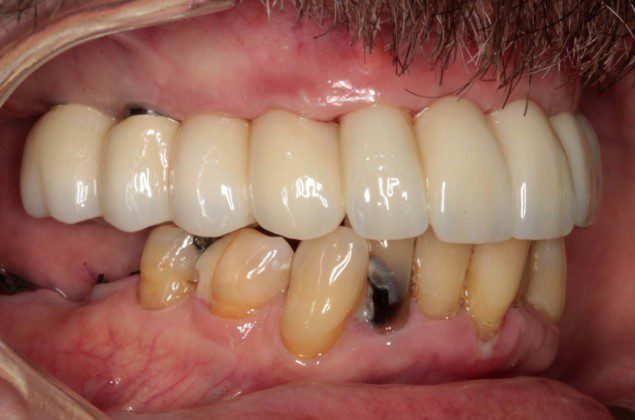 Right lateral (mirror) view of bridge. Note the “normal” contours that mimic natural teeth.