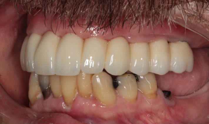 Right lateral (mirror) view of bridge. Note the “normal” contours that mimic natural teeth. Slight metal exposure of implant #4. Nothing can be “perfect” and we try to keep this from happening. However, some patients have existing bone loss that prevents perfection.