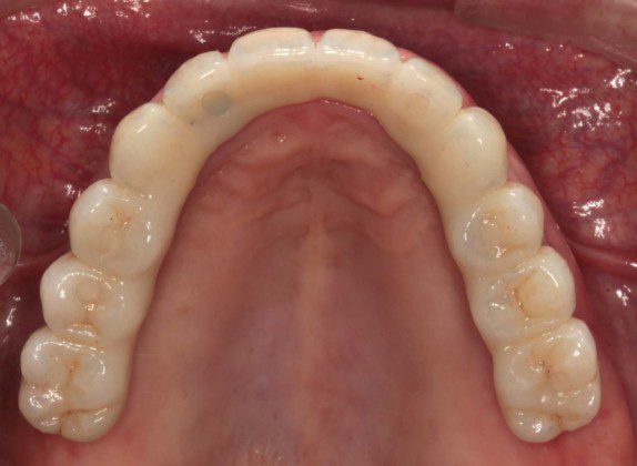 Mirror view of final implant bridge. The screw holes have been sealed with composite resin. This plastic filling material can be easily removed to remove and clean or service the bridge. We call this “retrievability”.