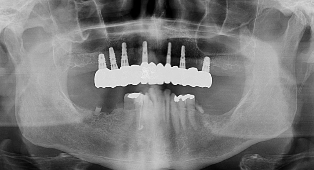Post-treatment panoramic x-ray. Note: no angled implants or abutments. Implants are placed where the roots of teeth were. Prosthesis is easily cleaned.