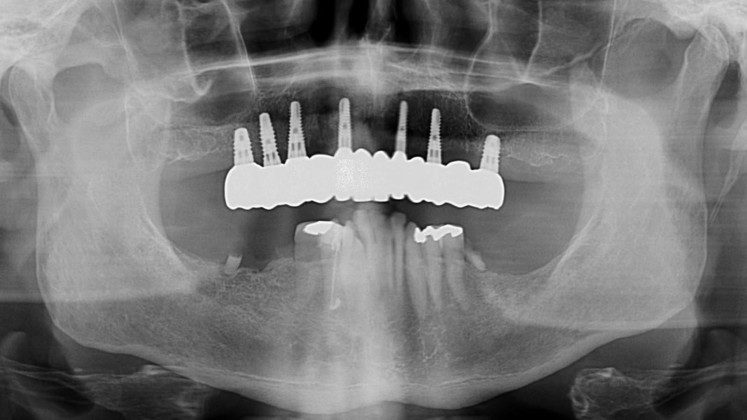 Post-treatment panoramic x-ray. Note: no angled implants or abutments. Implants are placed where the roots of teeth were. Prosthesis is easily cleaned.