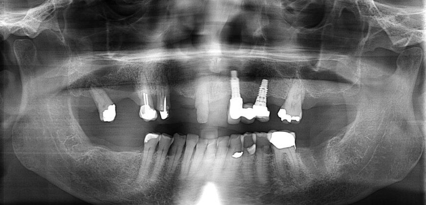 Pre-op panoramic image. Note: existing implants. Pre-op, frontal full-face smile.