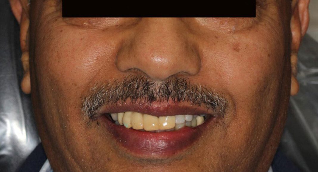 Pre-op, frontal full-face smile.