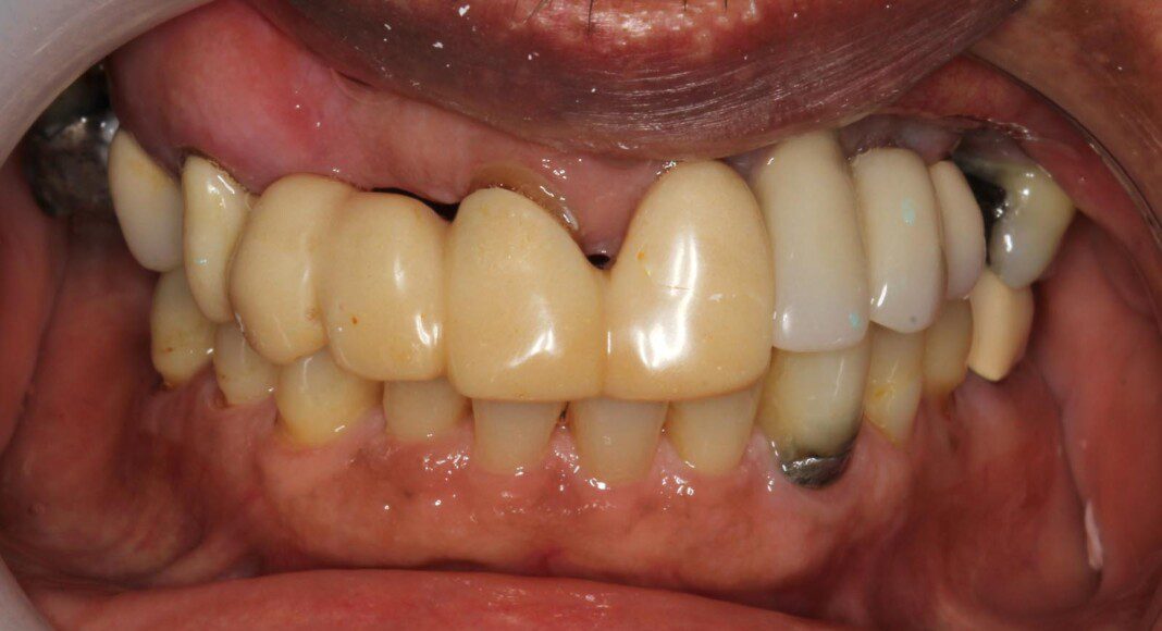 Pre-op, frontal full-face smile, lips retracted.