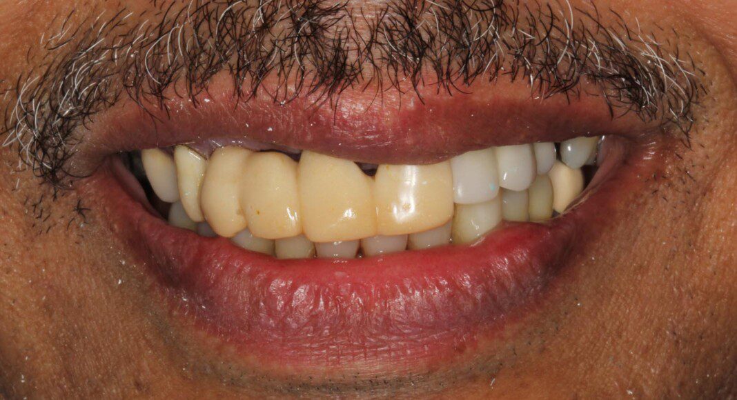 Pre-operative smile picture.