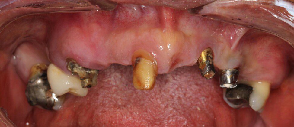 Pre-surgical view after removal of existing restorations. Existing implants were not perfect but reasonable. Better to use them than to try to remove and replace.