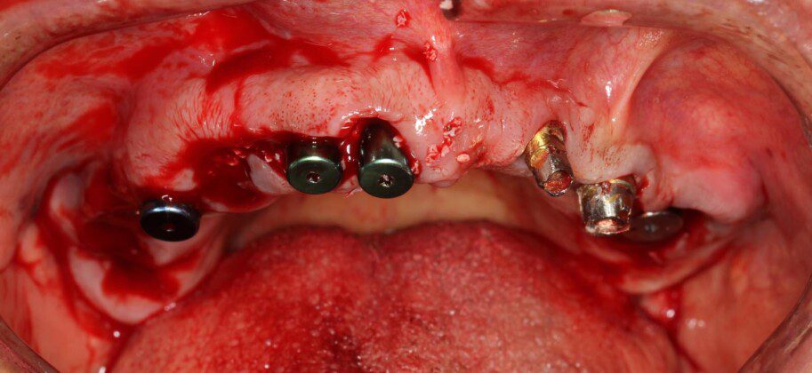 Post-surgical frontal picture. Some new implants were stable enough to place immediate temporary bridge on three new ones and two old ones.