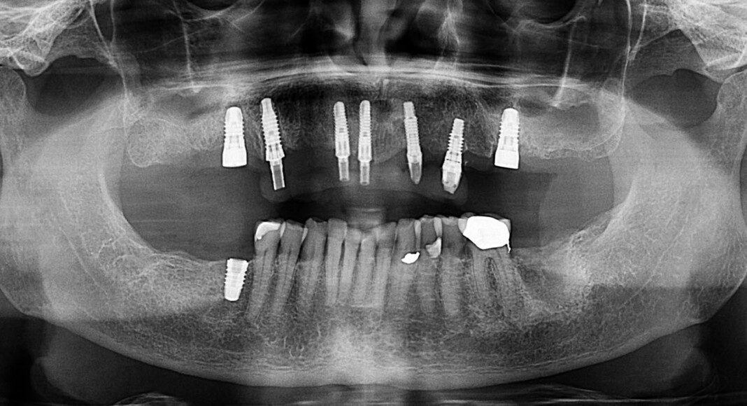 Post surgery panoramic image showing old and new implants.