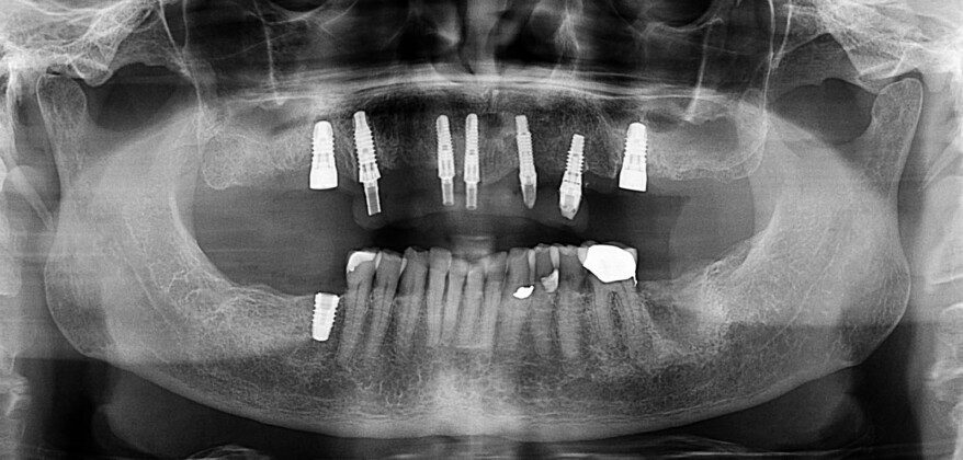 Post surgery panoramic image showing old and new implants.