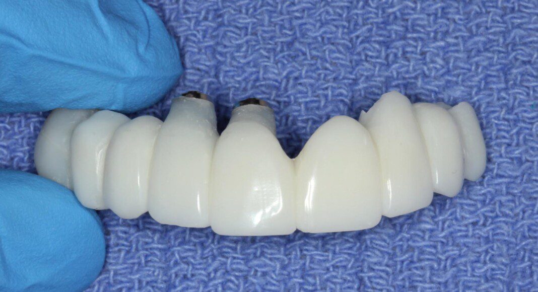 Acrylic temporary bridge fabricated the same day as surgery.