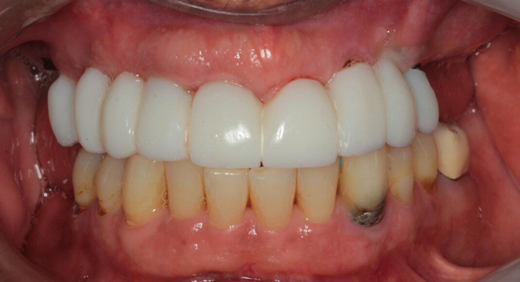 Three months later. Note amazing tissue response.