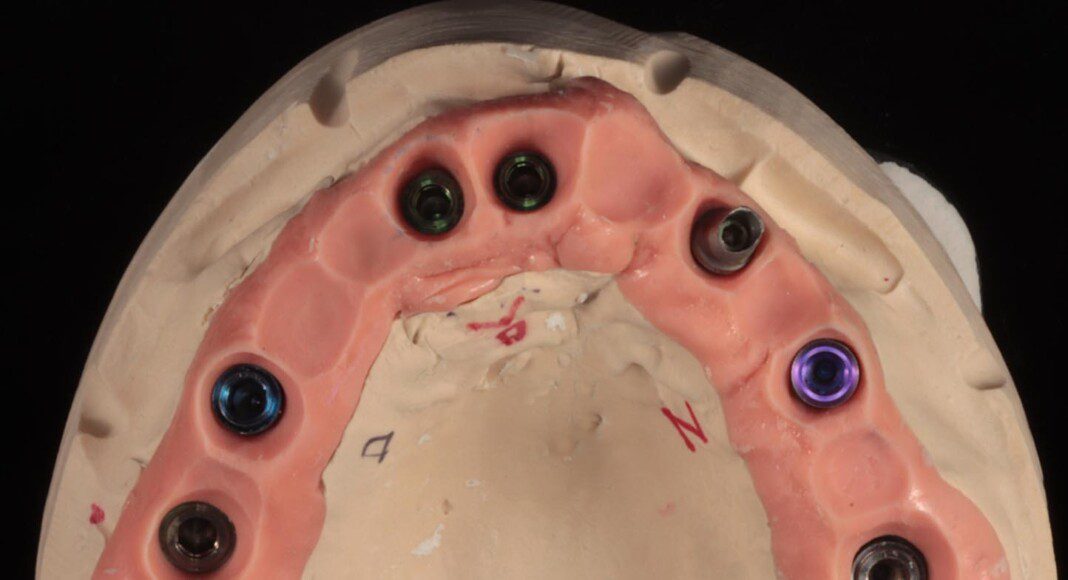 Master cast (occlusal view).