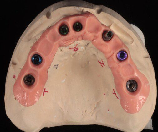 Master cast (occlusal view).
