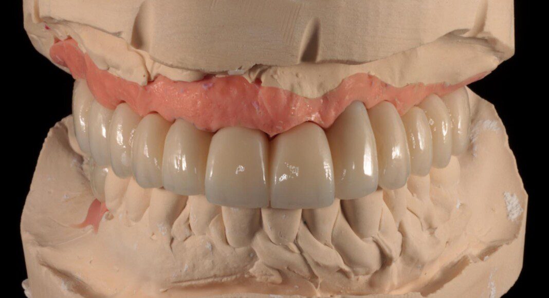 Final implant bridge on master cast (various views).