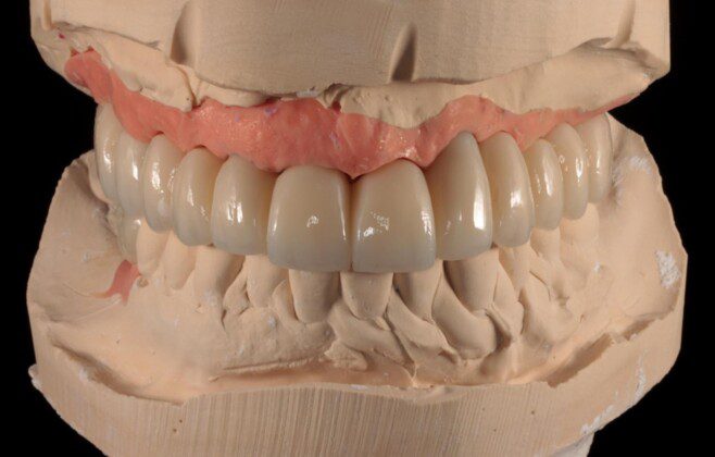 Final implant bridge on master cast (various views).