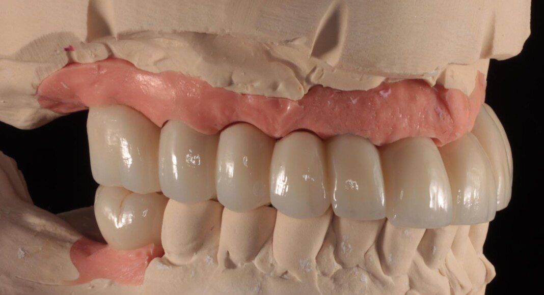 Final implant bridge on master cast (various views).