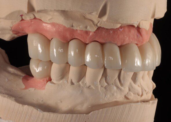 Final implant bridge on master cast (various views).