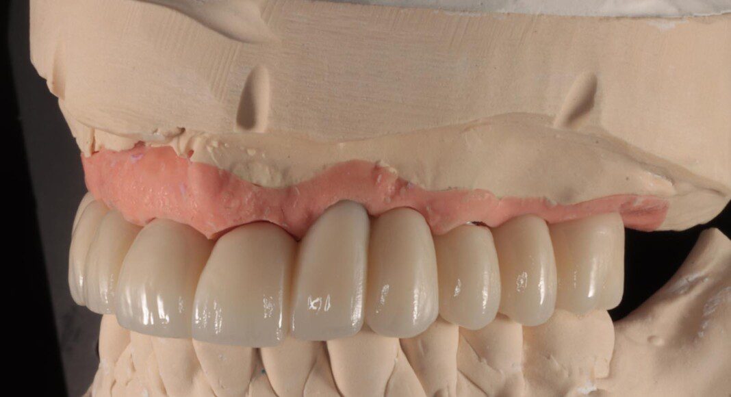 Final implant bridge on master cast (various views).
