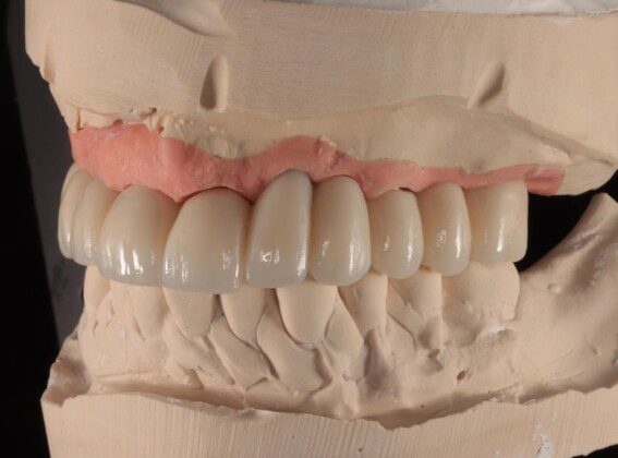 Final implant bridge on master cast (various views).