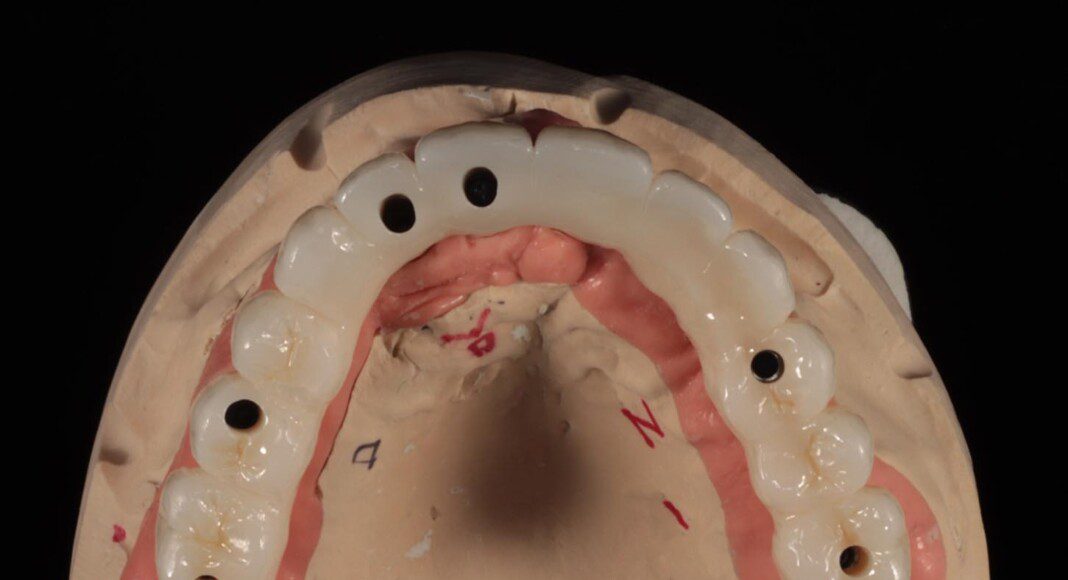 Final implant bridge on master cast (various views).