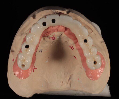 Final implant bridge on master cast (various views).