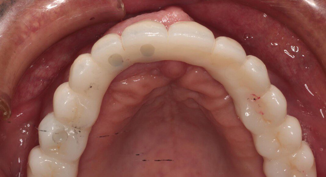Final, zirconia bridge (occlusal view, lips retracted).