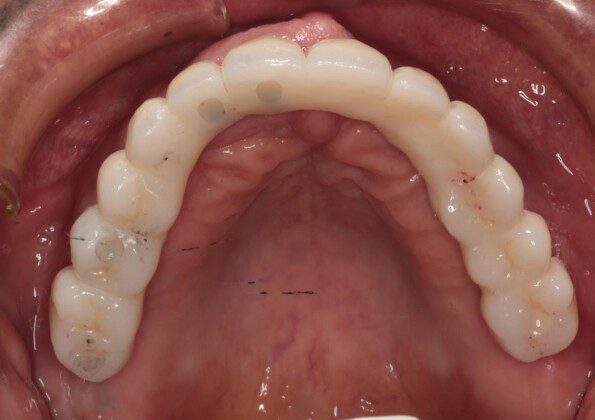 Final, zirconia bridge (occlusal view, lips retracted).