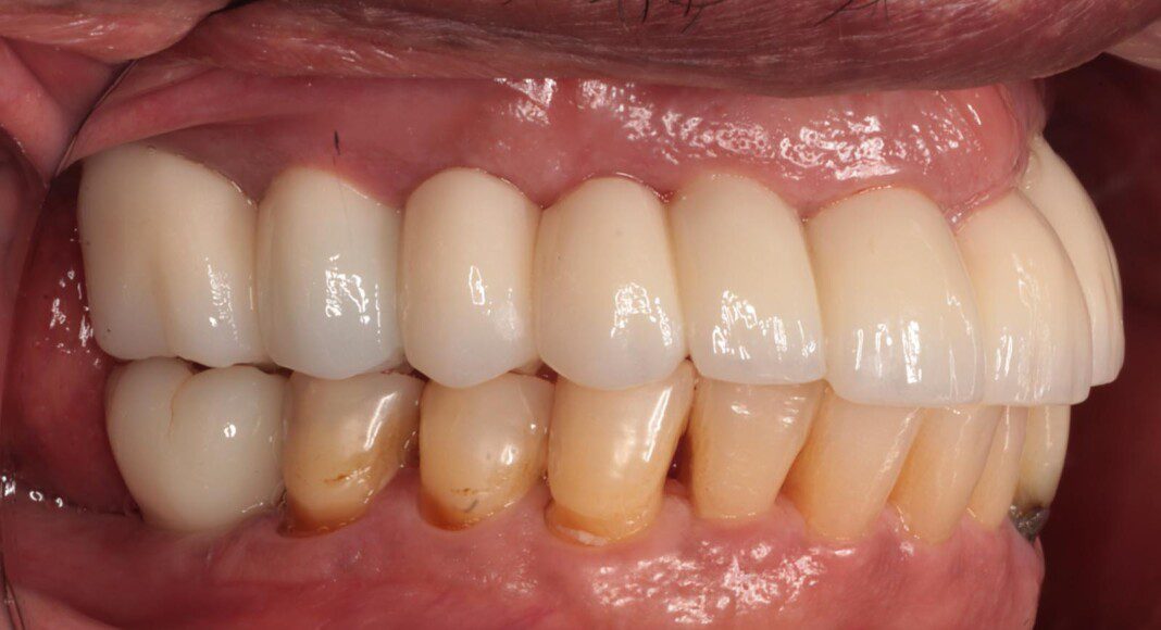 Final, zirconia bridge (right lateral view, lips retracted). Outstanding tissue and tooth contours.