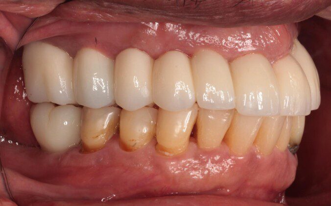 Final, zirconium bridge (right lateral view, lips retracted). Outstanding tissue and tooth contours.