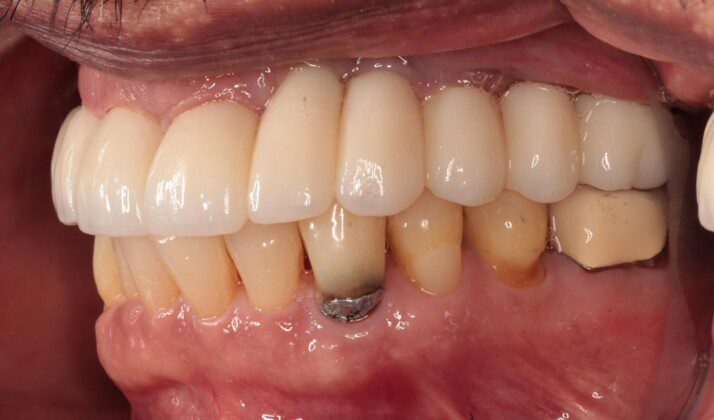 Left lateral (mirror) view of bridge. Existing implants (#s 10 and 12) are long. This is due to old implants being placed too deeply. As you will see in the smiling pictures, this does not adversely affect the outcome as the length of those teeth is not visible in his fullest smile.