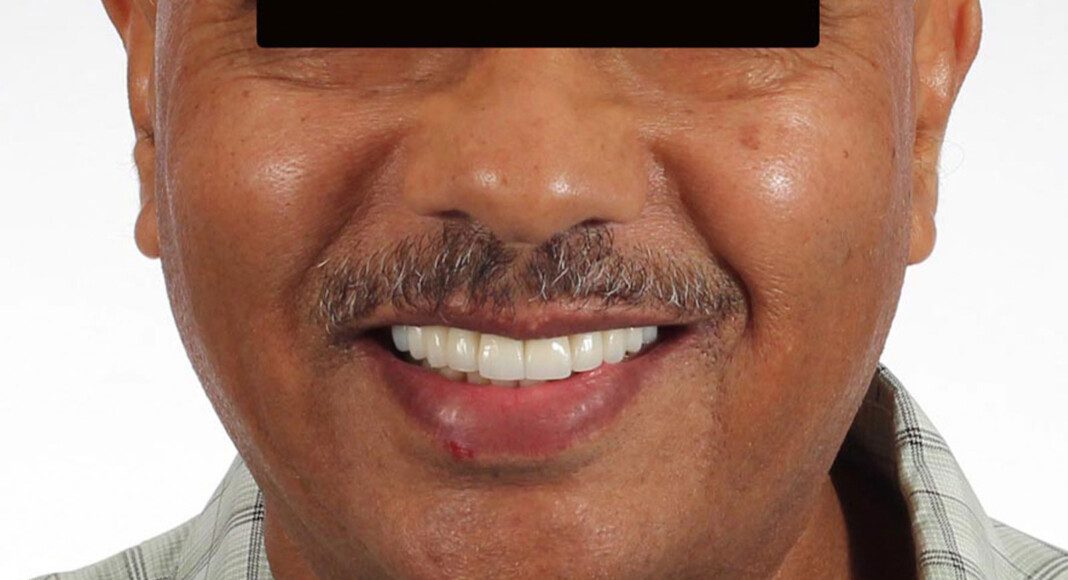 Full face smile.