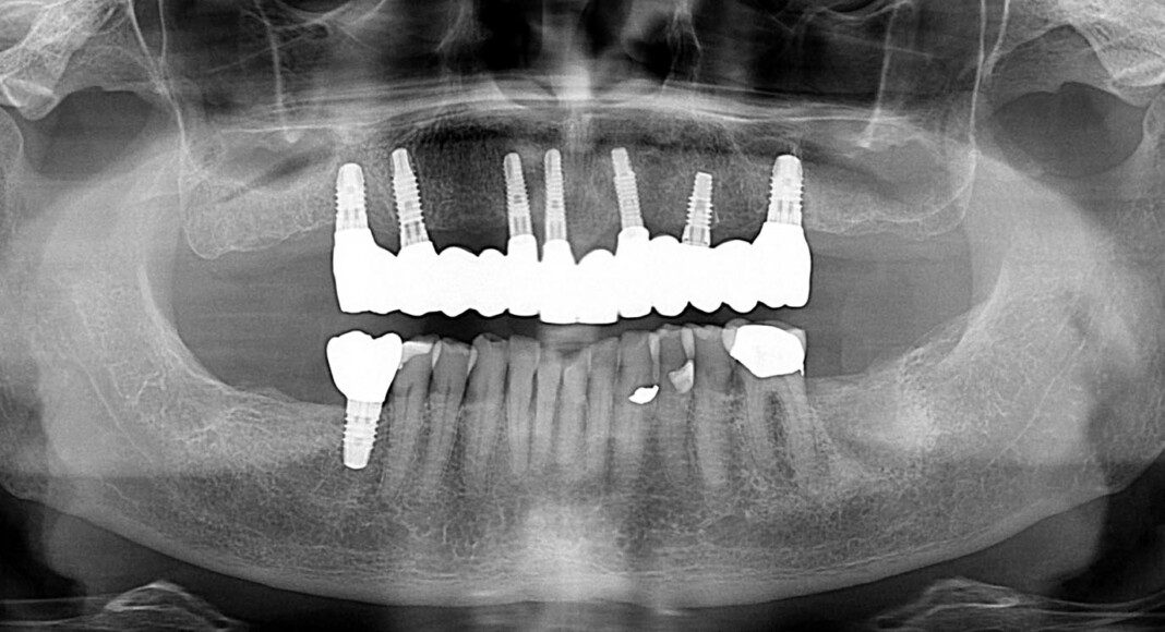 Post-treatment panoramic x-ray. Note: no angled implants or abutments. Implants are placed where the roots of teeth were. Prosthesis is easily cleaned.