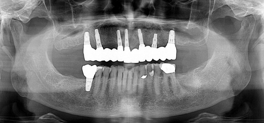 Post-treatment panoramic x-ray. Note: no angled implants or abutments. Implants are placed where the roots of teeth were. Prosthesis is easily cleaned.