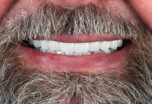 Full Mouth Implant Treatment