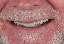 Full Mouth Implant Restoration