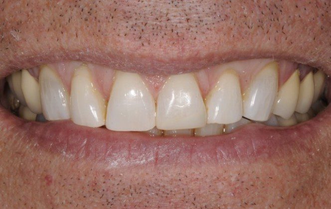 Composite Bonding of Worn/Fractured Teeth