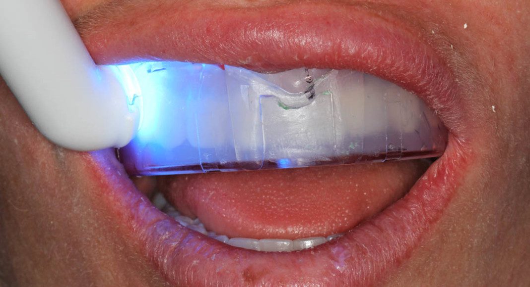 Cosmetic, A1 Veneers Dental Implant Center